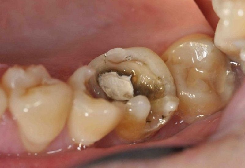 Răng bị sâu nhiều xảy ra khi men răng và ngà răng bị tổn thương do sự phát triển mạnh của vi khuẩn sâu răng trên bề mặt và các khe nhỏ giữa các răng.
