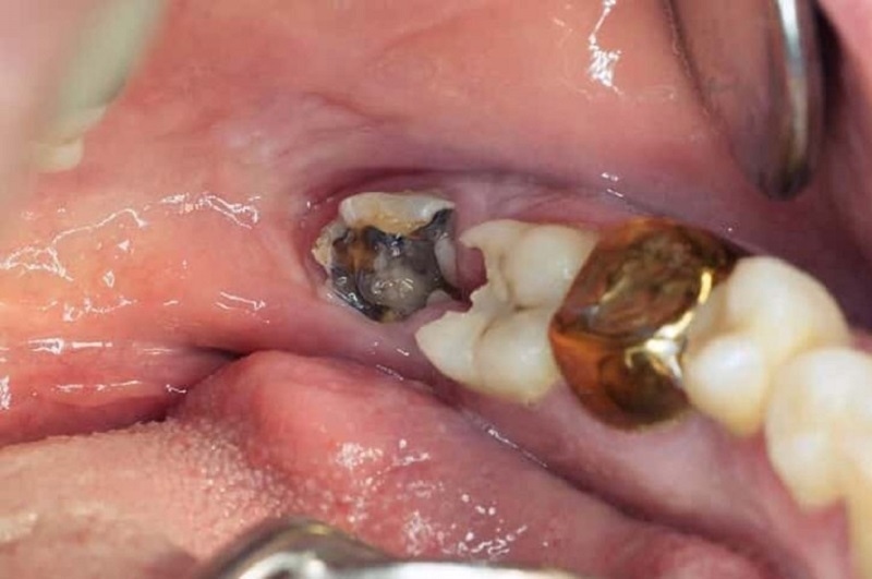 Răng khôn bị sâu có thể gây viêm nhiễm lây sang chi những răng kề cận