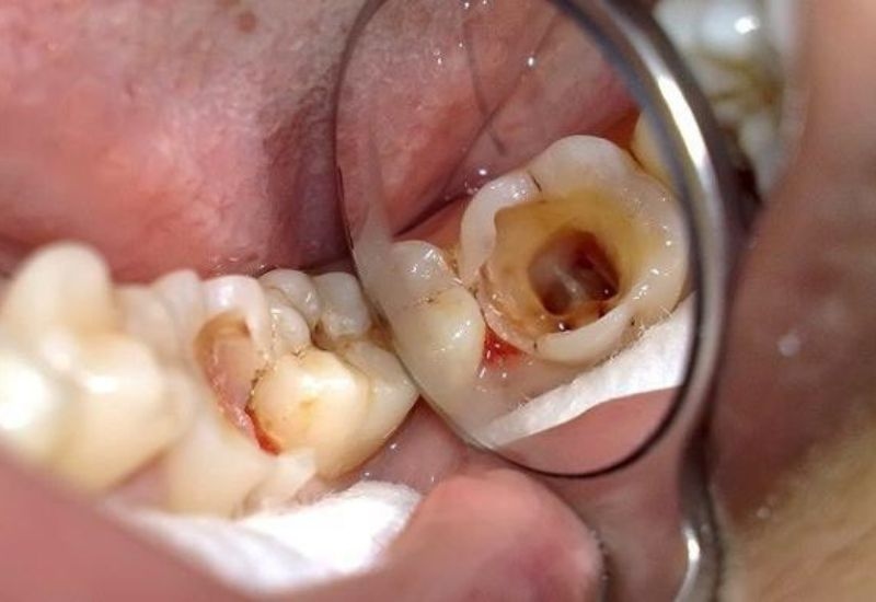 Sâu răng hàm trẻ em xảy ra khi lớp men răng bị bào mòn bởi acid do vi khuẩn trong miệng tạo ra.