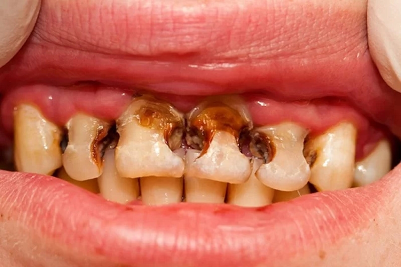 Sâu răng ở trẻ em có nguy hiểm không