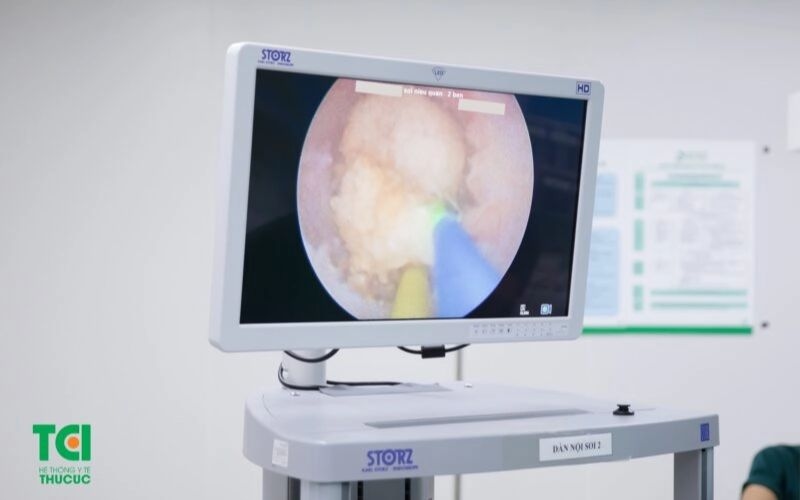 thận ứ nước mức độ 3