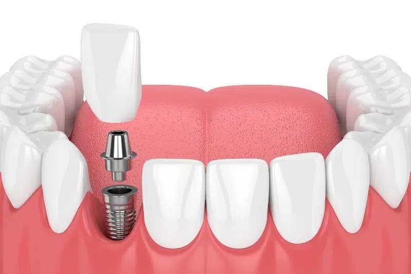 Trồng răng cửa: Nên chọn phương pháp phù hợp nhất với tình trạng răng miệng