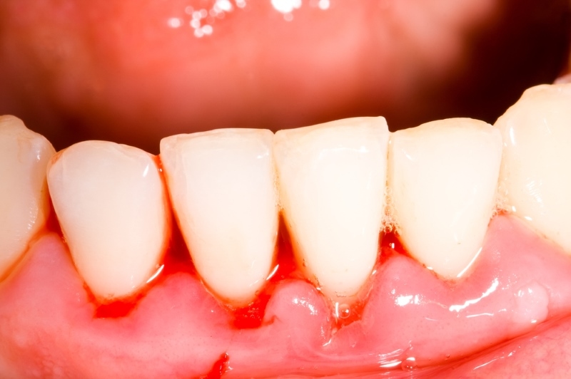 Viêm chân răng cửa là nguyên nhân hàng đầu gây sưng nướu răng