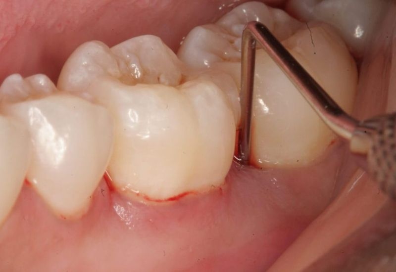 Nướu viêm nhiễm, sưng đỏ và đau là dấu hiệu điển hình của viêm lợi đau răng.