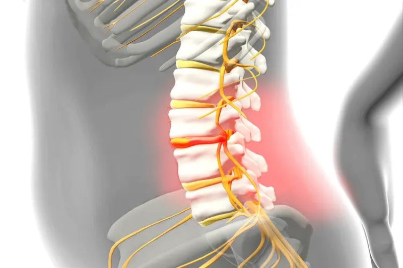 thoát vị đĩa đệm là gì