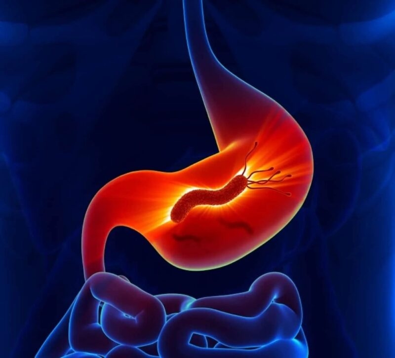 Trào ngược dạ dày càn được chẩn đoán và điều trị sớm để tránh biến chứng nặng hơn.