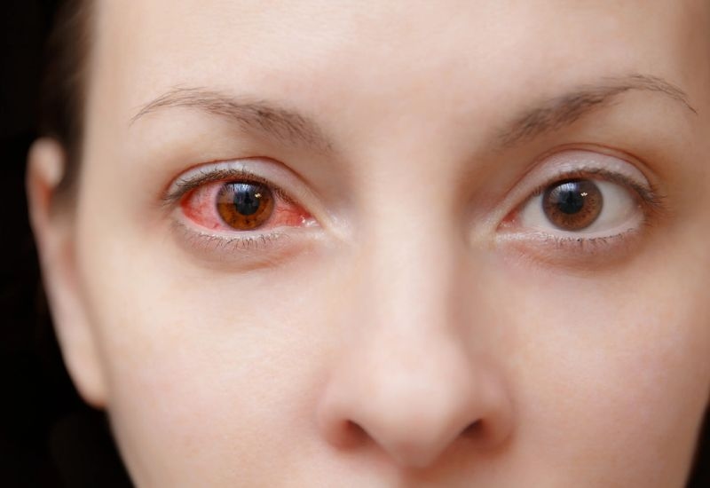 Triệu chứng của việc bị đau mắt đỏ