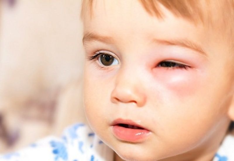 Các bệnh lý thường gặp ở kết mạc mắt