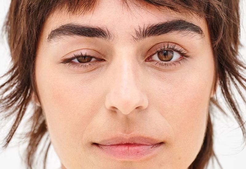 Mắt sụp mí ảnh hưởng đến thẩm mỹ