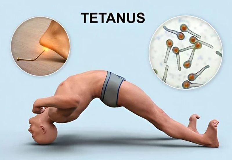 Tiêm ngừa uốn ván phòng bệnh nguy hiểm