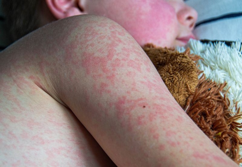 Vì sao cần tiêm vắc xin sởi