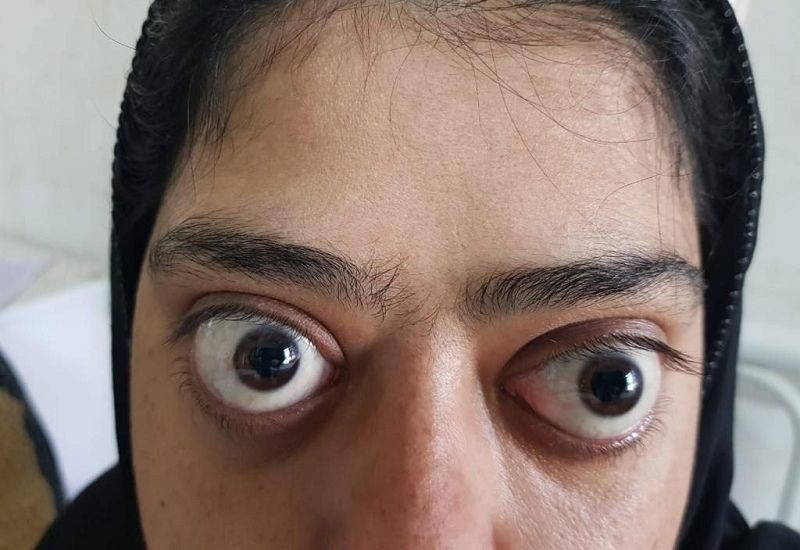 Nguyên nhân dẫn đến tình trạng mắt lồi nhẹ