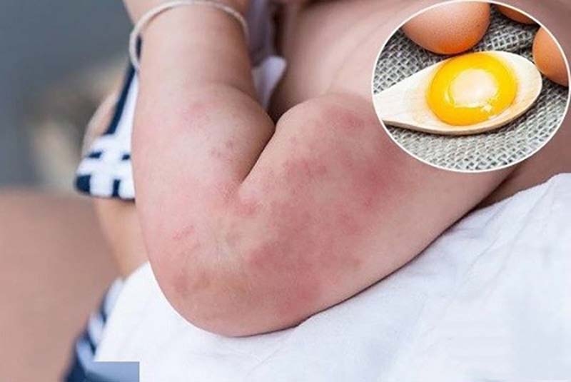 Tay trẻ bị mẩn đỏ do dị ứng, kèm lòng trứng trên muỗng, liên quan nguy cơ dị ứng trứng.