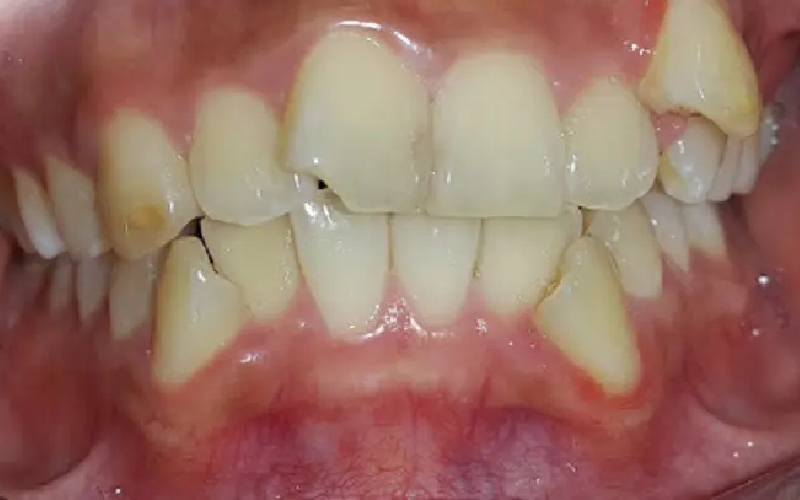 Hỏi Niềng răng có tốt không