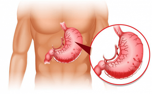 nguyên nhân bệnh tiêu hóa ở người cao tuổi