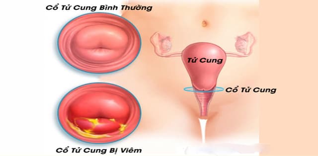 Xử trí viêm cổ tử cung mạn tính