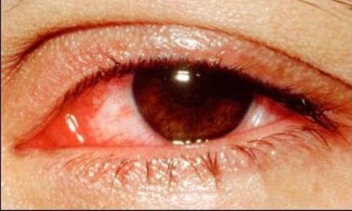 Bệnh nhân bị đau mắt đỏ
