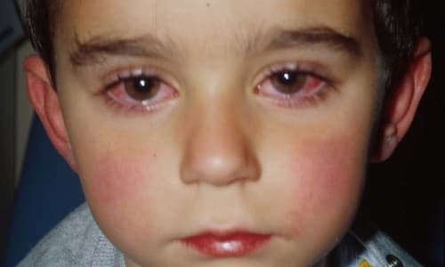 cac-benh-ve-mat-va-cach-dieu-tri