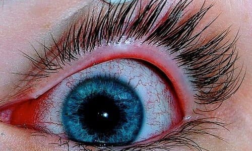 Đau mắt đỏ là căn bệnh dễ lây lan trong cộng đồng