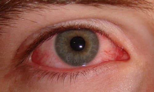 tri đau mắt đỏ