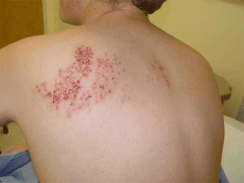 Bệnh viện Thu Cúc là lời giải cho câu hỏi khám bệnh zona thần kinh ở đâu của nhiều người.