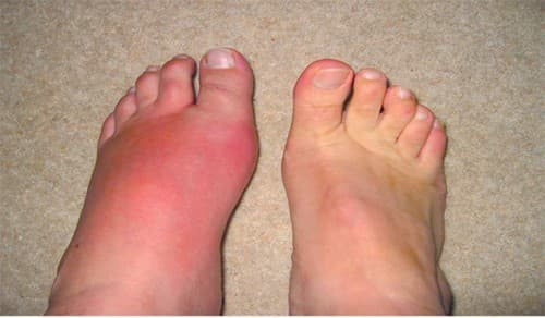 Khám bệnh Gout ở đâu tốt