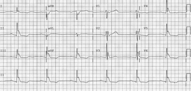 Điện tâm đồ là phương pháp giúp chẩn đoán chính xác bệnh rối loạn nhịp tim