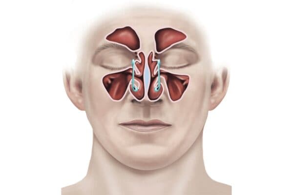 Viêm mũi xoang hình thành do viêm niêm mạc lớp lót trong hốc xoang