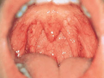 viem-hong-man-tinh-la-gi