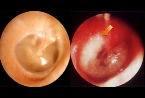 Ngoài ra, có một số yếu tố khác dẫn tới bệnh viêm tai giữa ở trẻ, phổ biến nhất là