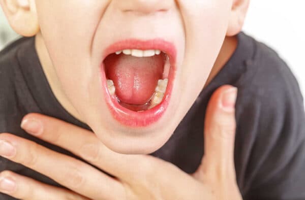 loét miệng ở trẻ