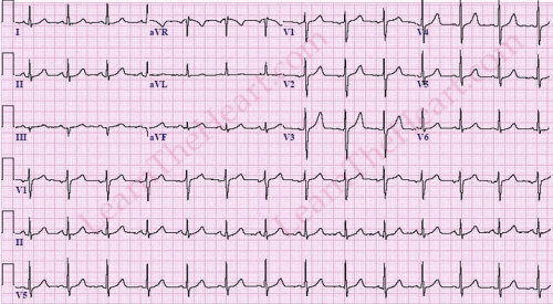 Rối loạn nhịp tim