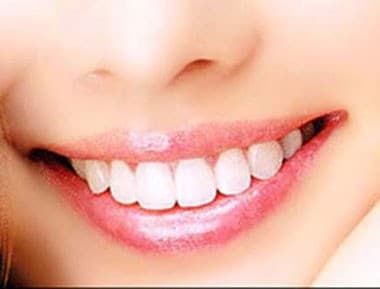 Niềng răng trong suốt phương pháp niềng răng đang được