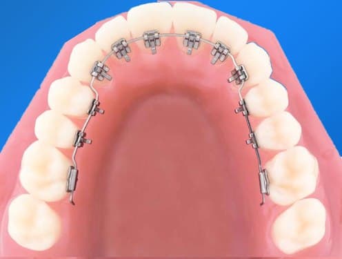 Niềng răng mặt trong tại Bệnh viện Đa Khoa Quốc Tế Thu Cúc