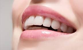 Niềng răng mắc cài sứ