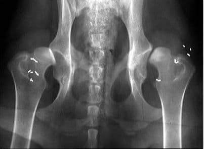 Thoái hóa khớp háng khiến người bệnh đi lại khó khăn vì khớp này gánh trọng lượng cơ thể nhiều nhất