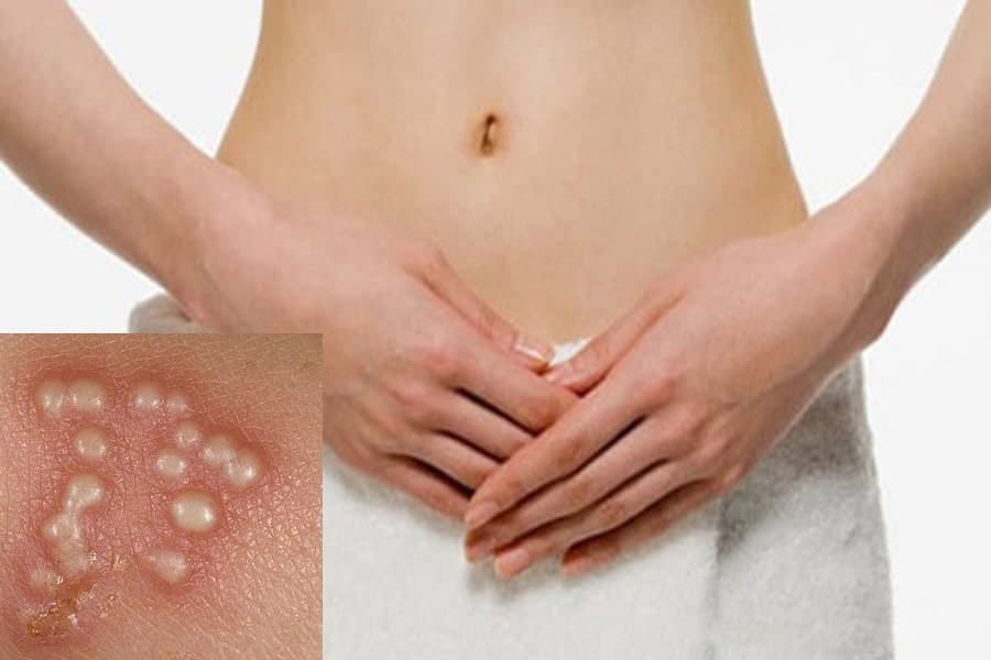 Bệnh lây qua đường tình dục ở nữ giới