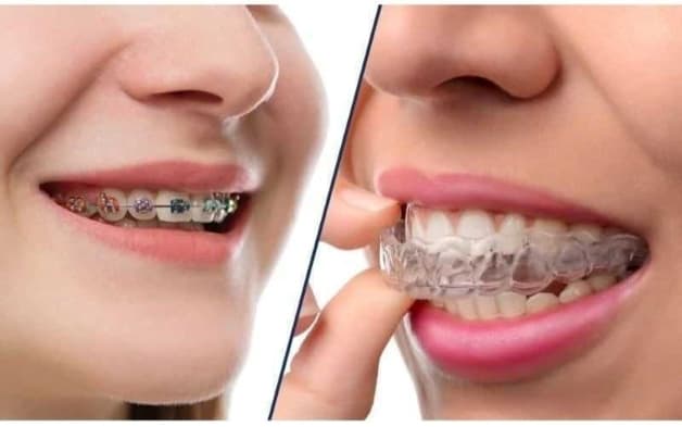 niềng răng quặp