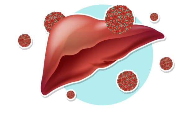 Các tế bào bị viêm nhiễm gây rối loạn chức năng gan.