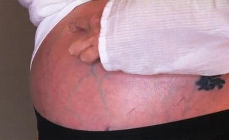 benh-xo-gan-giai-doan-cuoi