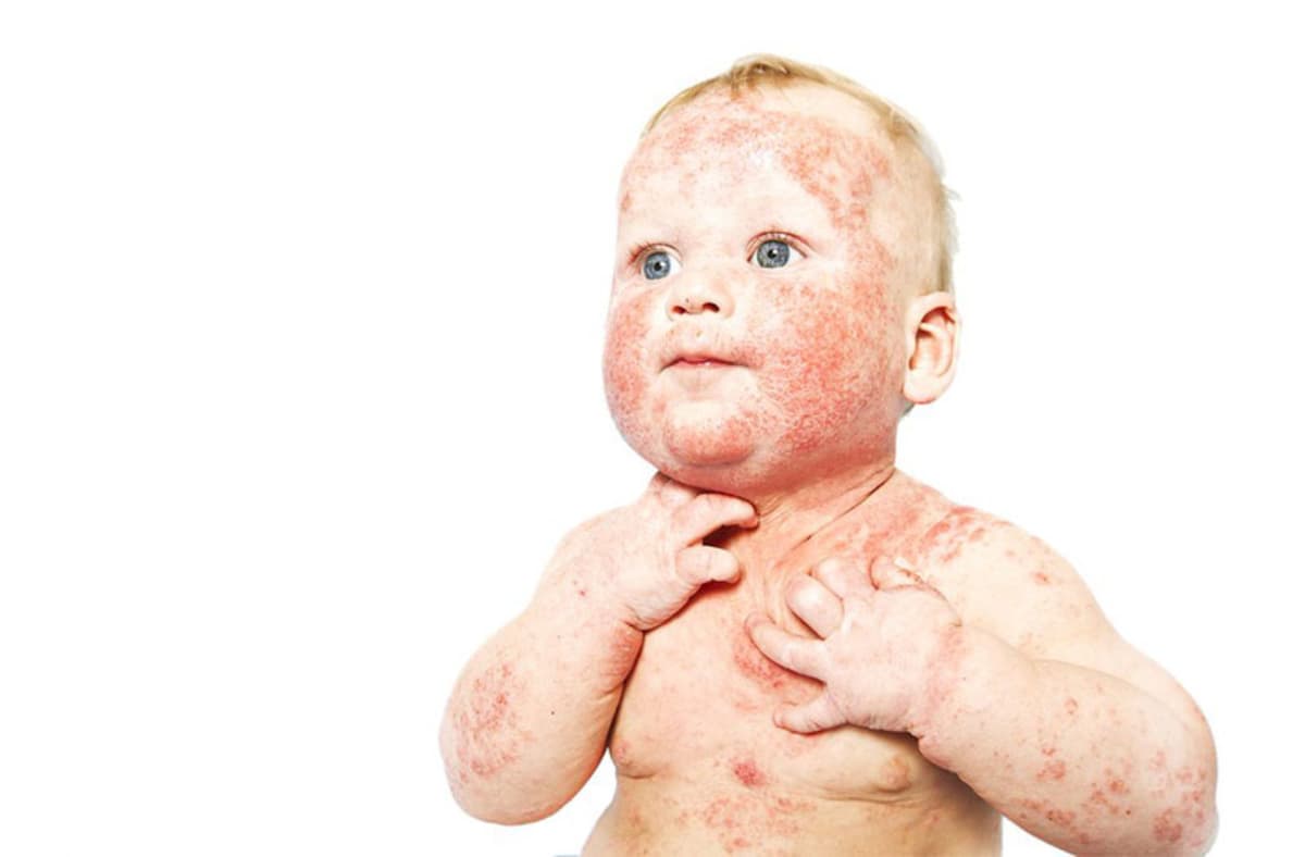 Bệnh ngoài da ở trẻ em: Thông tin bố mẹ cần biết
