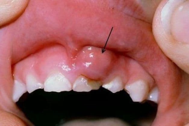 Các bệnh răng miệng ở trẻ em: Viêm nướu miệng