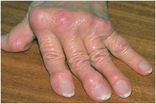 Cơ chế bệnh sinh của bệnh gout