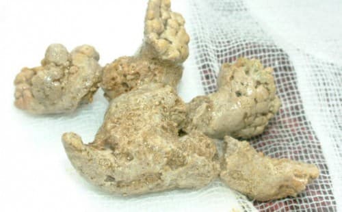 Sỏi san hô thường là sỏi hỗn hợp struvite – carbonate-apatite