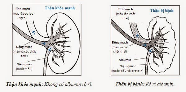 Suy thận độ 1 không thể chữa khỏi được và sẽ ngày