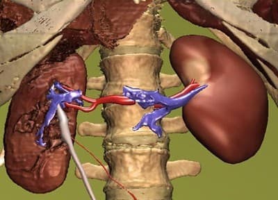 Suy thận giai đoạn cuối cần làm gì trong những ngày cuối