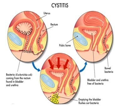 Viêm đường tiết niệu chữa như thế nào?