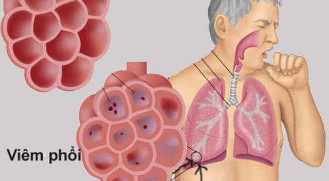 Viêm phổi có nguy hiểm không