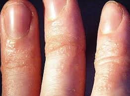 Bệnh chàm tổ đỉa những đám mảng đỏ da