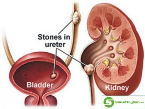 Sỏi thận là một trong những bệnh khó được phát hiện sớm 